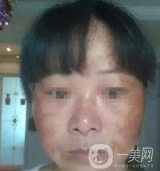 廣東省人民醫(yī)院整形科價(jià)格表，附祛斑整形日記