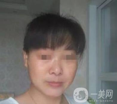 廣東省人民醫(yī)院整形科價(jià)格表，附祛斑整形日記