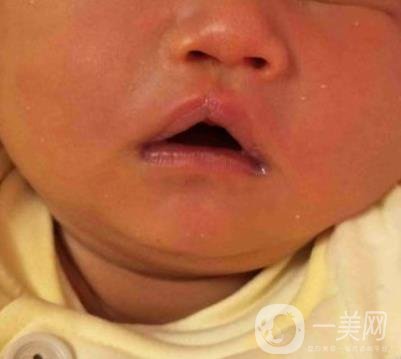 昆明醫(yī)科大學(xué)第一附屬醫(yī)院整形科價(jià)格表，內(nèi)附兔唇矯正案例
