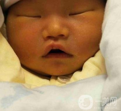 昆明醫(yī)科大學(xué)第一附屬醫(yī)院整形科價(jià)格表，內(nèi)附兔唇矯正案例