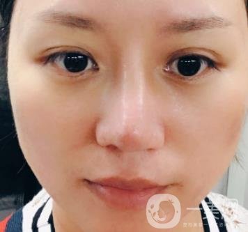 張掖市人民醫(yī)院美容整形科價格表，附眼袋切除*果圖