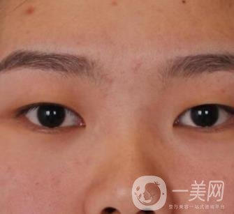 北京醫(yī)院整形項目2020年價格表一覽，內(nèi)附錢文江開眼角案例