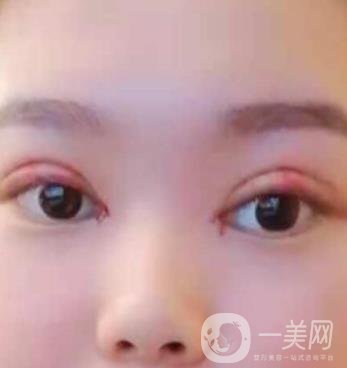 北京醫(yī)院整形項目2020年價格表一覽，內(nèi)附錢文江開眼角案例