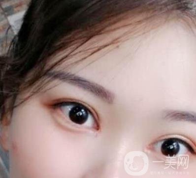 北京醫(yī)院整形項目2020年價格表一覽，內(nèi)附錢文江開眼角案例