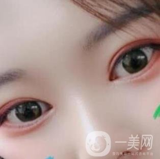 北京醫(yī)院整形項目2020年價格表一覽，內(nèi)附錢文江開眼角案例