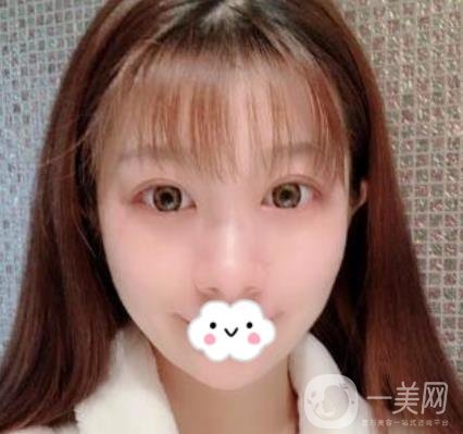 湖南省人民醫(yī)院割雙眼皮要多少錢(qián)？整形價(jià)格表一覽