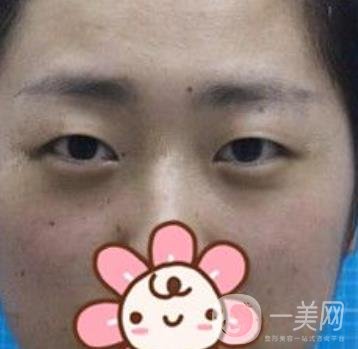 秦皇島人民醫(yī)院雙眼皮怎么樣？附整形價格表及案例圖