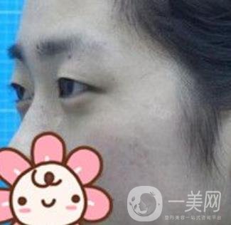秦皇島人民醫(yī)院雙眼皮怎么樣？附整形價格表及案例圖