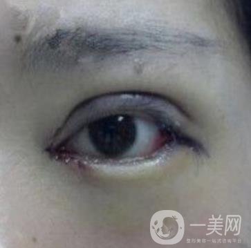 秦皇島人民醫(yī)院雙眼皮怎么樣？附整形價格表及案例圖