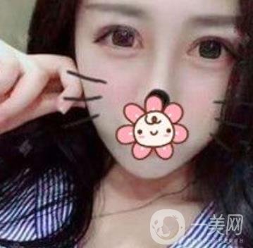 秦皇島人民醫(yī)院雙眼皮怎么樣？附整形價格表及案例圖