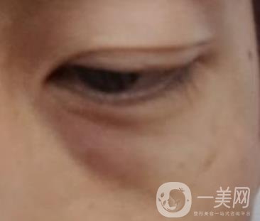 寶雞市人民醫(yī)院去眼袋