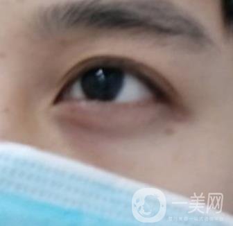 寶雞市人民醫(yī)院去眼袋