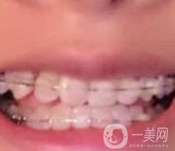 蘭山區(qū)人民醫(yī)院整牙