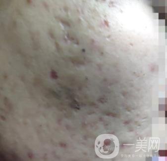 綿陽中心醫(yī)院整形美容科祛痘坑怎么樣？價格表及術后*果分享