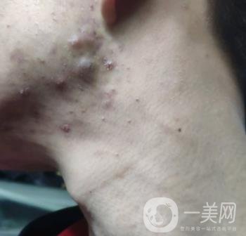 綿陽中心醫(yī)院整形美容科祛痘坑怎么樣？價格表及術后*果分享