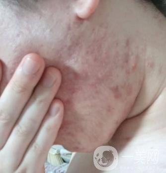 綿陽中心醫(yī)院整形美容科祛痘坑怎么樣？價格表及術后*果分享