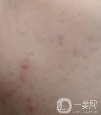 綿陽中心醫(yī)院整形美容科祛痘坑怎么樣？價格表及術后*果分享