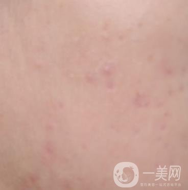 綿陽中心醫(yī)院整形美容科祛痘坑怎么樣？價格表及術后*果分享