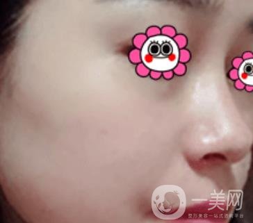 岳陽(yáng)市第一人民醫(yī)院整形美容科祛斑好嗎？?jī)r(jià)格表和案例日記分享