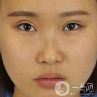 河北省中醫(yī)院整形美容科隆鼻怎么樣？價格表及術后恢復日記分享