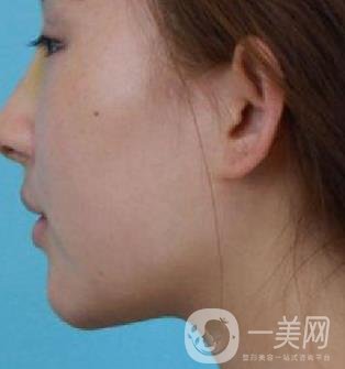 河北省中醫(yī)院整形美容科隆鼻怎么樣？價格表及術后恢復日記分享