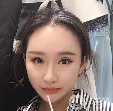 河北省中醫(yī)院整形美容科隆鼻怎么樣？價格表及術后恢復日記分享