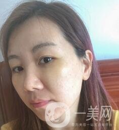 贛州市人民醫(yī)院整形科價(jià)格表，附祛眼袋案例分享