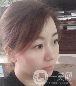 贛州市人民醫(yī)院整形科價(jià)格表，附祛眼袋案例分享