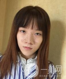 南昌二附院整形科價格表2020，附肋軟骨隆鼻整形案例