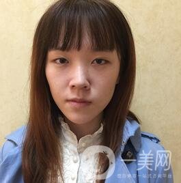 南昌二附院整形科價格表2020，附肋軟骨隆鼻整形案例