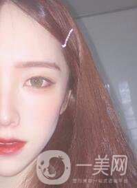 南昌二附院整形科價格表2020，附肋軟骨隆鼻整形案例