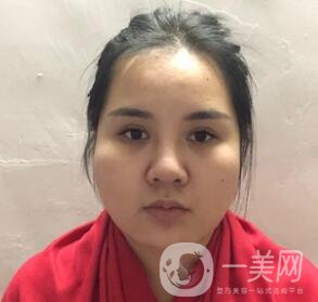 景德鎮(zhèn)第一人民醫(yī)院整形科價格表，附面部吸脂瘦臉案例