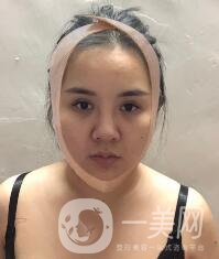 景德鎮(zhèn)第一人民醫(yī)院整形科價格表，附面部吸脂瘦臉案例