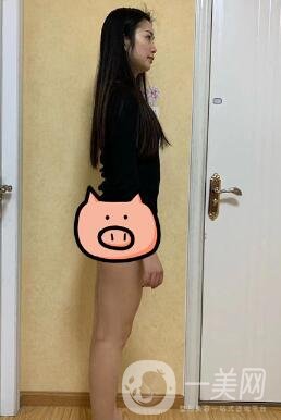 福建省立醫(yī)院整形科價格(目)表2020，附大小腿吸脂案例