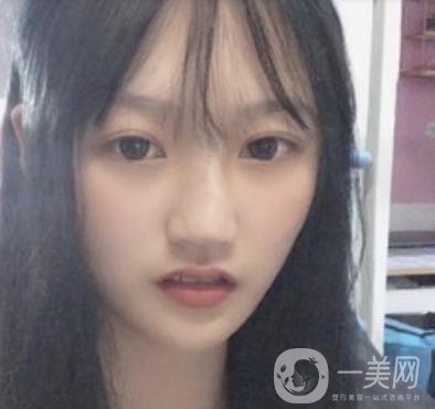 北京醫(yī)院趙紅藝做鼻子多少錢?價(jià)格表和真人*果變化圖一覽