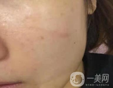 西安市中心醫(yī)院整形科價目價格一覽，附陶諫祛疤案例*果圖