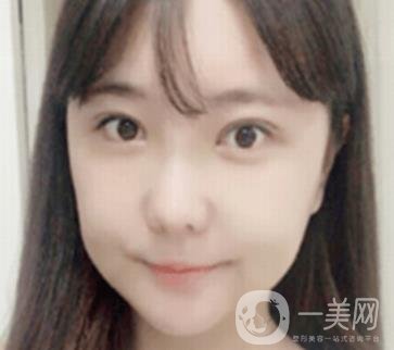 廣州博仕整形醫(yī)院做鼻子多少錢?價(jià)格表和整形恢復(fù)日記一覽