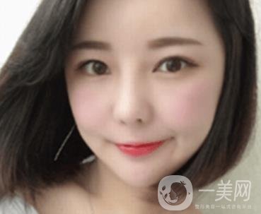 廣州博仕整形醫(yī)院做鼻子多少錢?價(jià)格表和整形恢復(fù)日記一覽