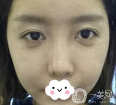 泉州二院整形外科可以打玻尿酸嗎？附價格表及玻尿酸隆鼻案例