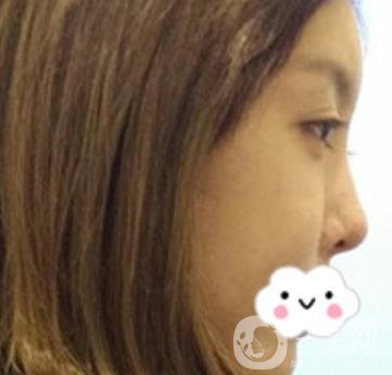 泉州二院整形外科可以打玻尿酸嗎？附價格表及玻尿酸隆鼻案例