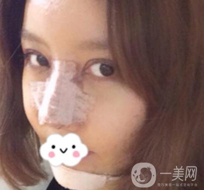 泉州二院整形外科可以打玻尿酸嗎？附價格表及玻尿酸隆鼻案例