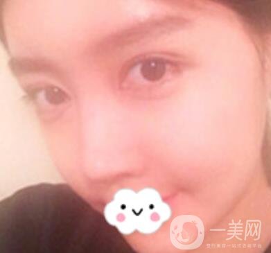 泉州二院整形外科可以打玻尿酸嗎？附價格表及玻尿酸隆鼻案例