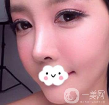 泉州二院整形外科可以打玻尿酸嗎？附價格表及玻尿酸隆鼻案例