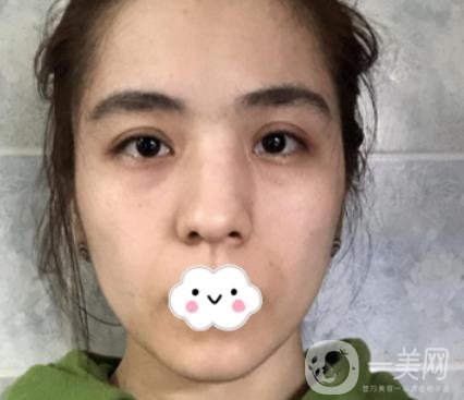 上海伯思立整形怎么樣？附沈國雄隆鼻案例及整形價(jià)格表