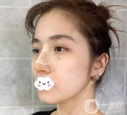 上海伯思立整形怎么樣？附沈國雄隆鼻案例及整形價(jià)格表