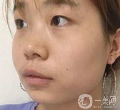 上海華美李志海磨骨多少錢？案例有嗎？整形價格表一覽
