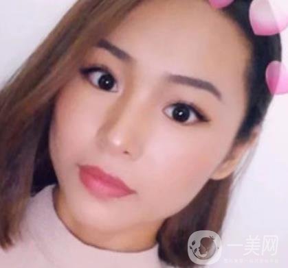 上海九院切下頜角手術經歷分享，附2020整形價格一覽表