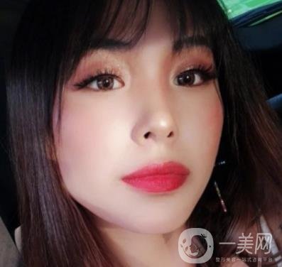 上海九院切下頜角手術經歷分享，附2020整形價格一覽表