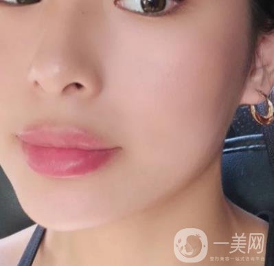 上海九院切下頜角手術經歷分享，附2020整形價格一覽表