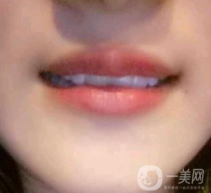 北京市海淀醫(yī)院整牙多少錢？看價(jià)格表及案例*果